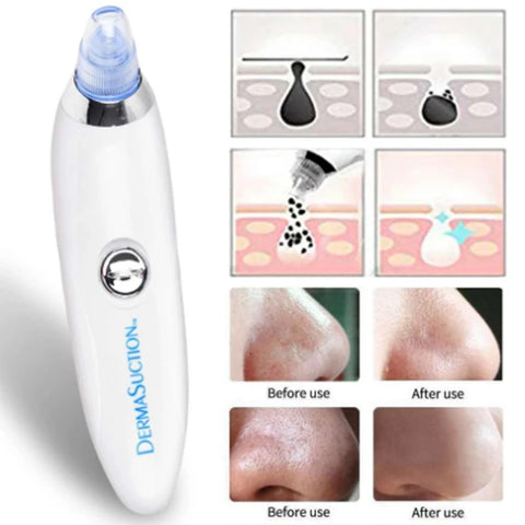 4 IN 1 DERMA VACUUM SUCTION BLACKHEAD/ACNE/OIL/PORE CLEANER